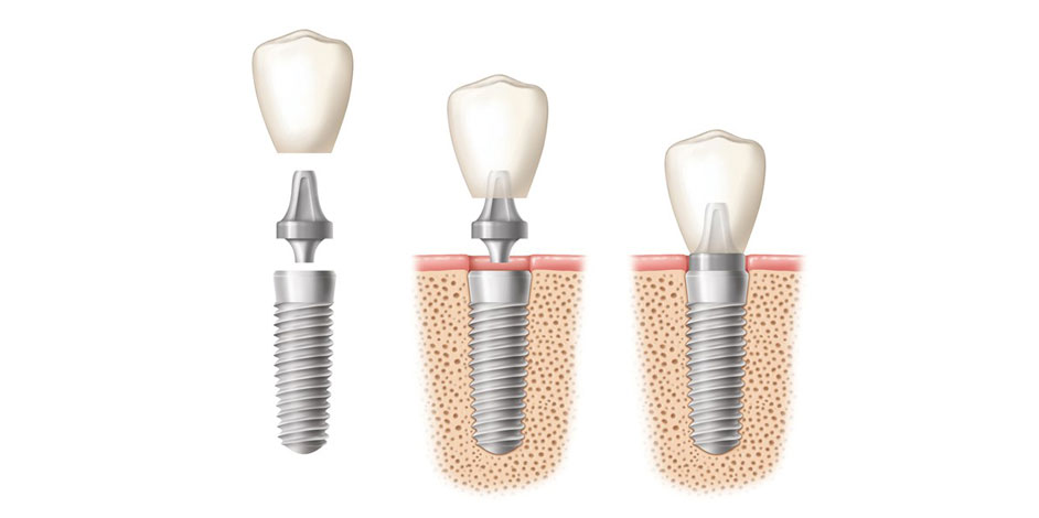 Photo of Dental Implants